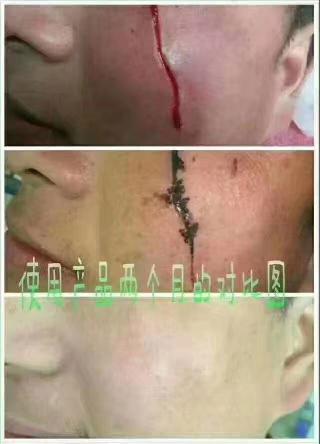疤痕修复案例
